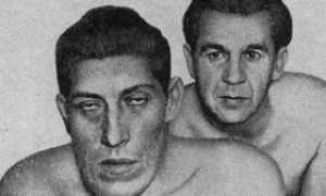 Акромегалия, огрубение черт лица и пр. — причины, симптомы, лечение