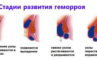 Наружный геморрой: симптомы, причины и лечение
