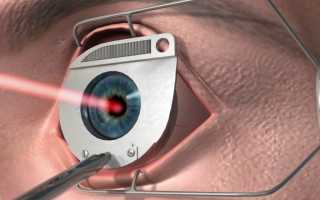 Лазерная коррекция зрения Lasik