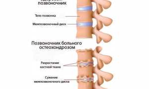 Остеохондроз грудного отдела позвоночника — причины и лечение