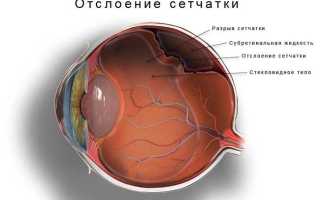 Отслоение сетчатки глаза — как вовремя распознать и чем лечить болезнь?