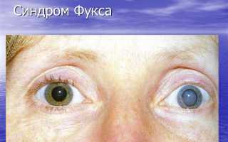 Синдром Фукса