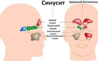 Причины синусита у взрослого, симптомы и лечение заболевания, виды