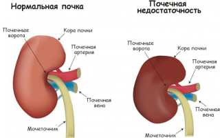 Острая почечная недостаточность