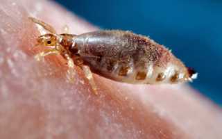 Завелись вши? Узнайте, как избавиться от них в домашних условиях