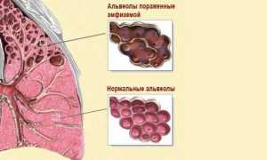 Эмфизема легких — чем грозит заболевание? Симптомы, профилактика, лечение