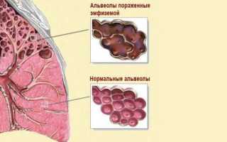 Эмфизема легких — чем грозит заболевание? Симптомы, профилактика, лечение