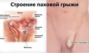 Паховая грыжа у мужчин — как проявляется и что делать?