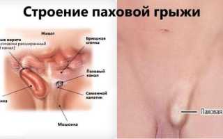 Паховая грыжа у мужчин — как проявляется и что делать?