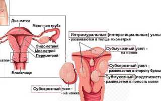 Что такое миома матки — причины, признаки, лечение. Опасности заболевания