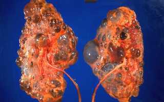 Поликистозная болезнь почек (Поликистоз почек)