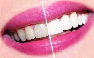 Отбеливание зубов дома самостоятельно, против профессиональных методов отбеливания