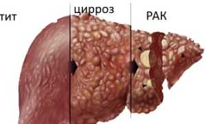 Как появляется цирроз печени? Причины, симптомы и методы лечения печёночного цирроза