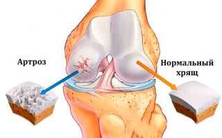 Симптомы артроза коленного сустава, лечение в домашних условиях