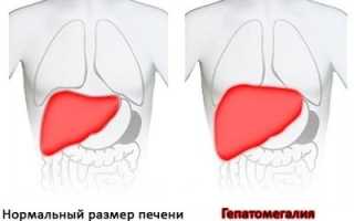 Увеличена печень — каковы причины, симптомы и лечение