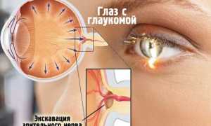 Как предупредить глаукому?
