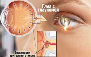 Как предупредить глаукому?