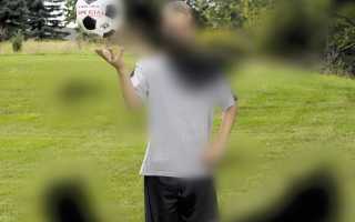 Скотомы в поле зрения