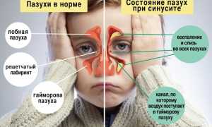 Синусит у детей — что это такое? Симптомы и лечение