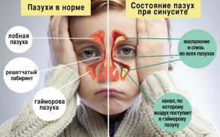 Синусит у детей — что это такое? Симптомы и лечение