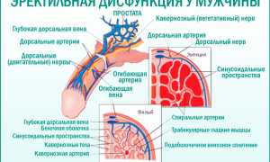 Эректильная дисфункция (импотенция, мужская сексуальная дисфункция)