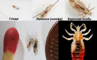 Изоляция ребенка с педикулезом