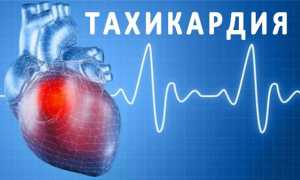 Причины и симптомы тахикардии, виды заболевания и способы лечения