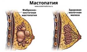 Как проявляется мастопатия молочных желез? Симптомы и лечение патологии