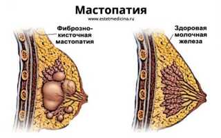 Как проявляется мастопатия молочных желез? Симптомы и лечение патологии