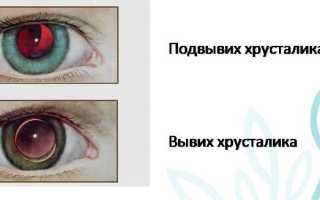 Смещение хрусталика глаза