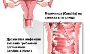 Причины заболевания молочницей и психологические факторы