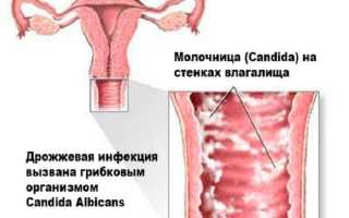 Причины заболевания молочницей и психологические факторы