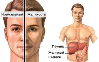Синдром Жильбера – что это? Симптомы болезни и методы лечения