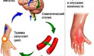 Комплексный региональный болевой синдром
