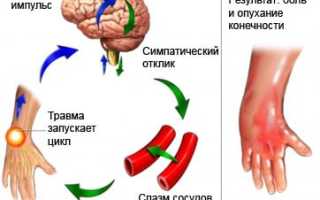 Комплексный региональный болевой синдром