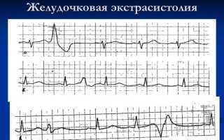 Что такое желудочковая экстрасистолия – всё о сердечной патологии
