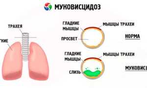 Муковисцидоз — симптомы и лечение генетического заболевания