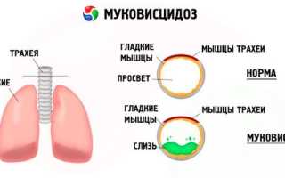 Муковисцидоз — симптомы и лечение генетического заболевания