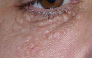 Жировик под глазом