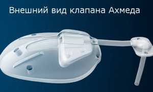 Аппарат Ахмеда