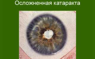 Причины и лечение осложненной катаракты