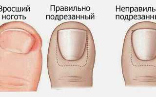 Вросший ноготь на большом пальце ноги – лечение в больнице и домашних условиях