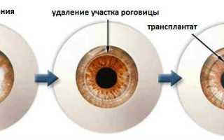 Замена роговицы глаза