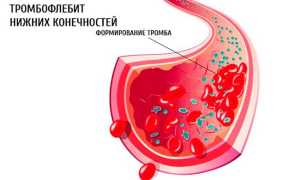 Тромбофлебит нижних конечностей — его симптомы и методы лечения