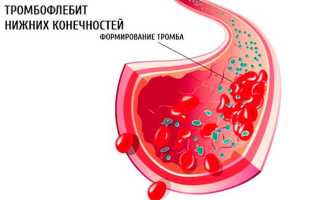 Тромбофлебит нижних конечностей — его симптомы и методы лечения