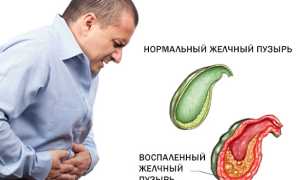 Холецистит у взрослых: симптомы, лечение, рекомендации по питанию