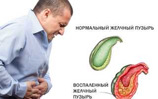 Холецистит у взрослых: симптомы, лечение, рекомендации по питанию