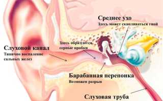 Отит у взрослых — как не допустить осложнений? Симптомы, лечение в домашних условиях