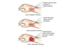 Что делать при ожоге кипятком? Первая помощь и лечение