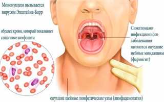 Мононуклеоз у взрослых — причины, симптомы и лечение